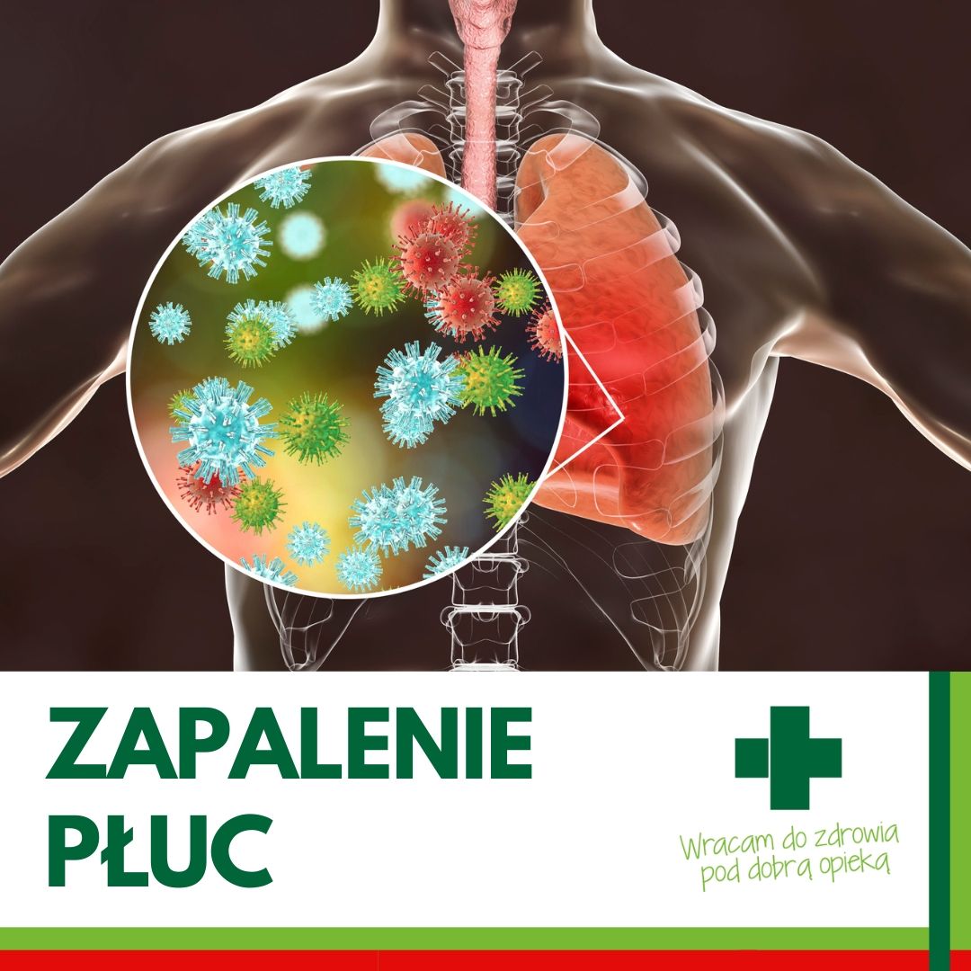 Zapalenie płuc – jak je leczyć prawidłowo?